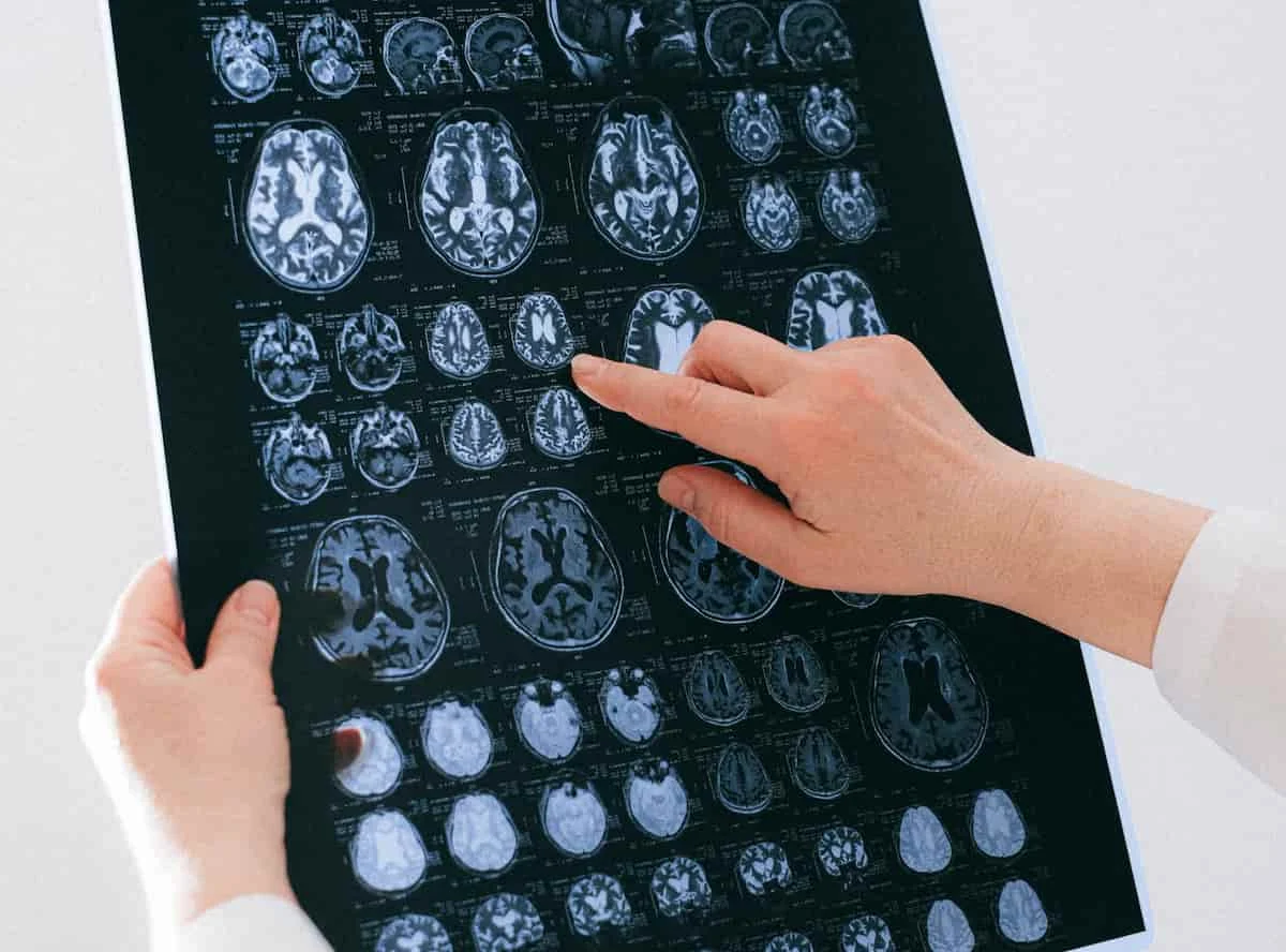 Depression Alters Brain’s White Matter Structure, Large-Scale Study Reveals