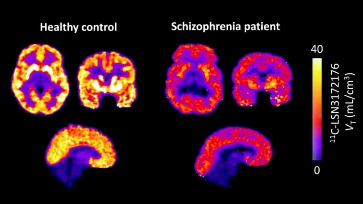 Groundbreaking PET Study Reveals Widespread M1 Receptor Deficits in Living Schizophrenia Patients, Paving Way for Non-Dopaminergic Treatments.